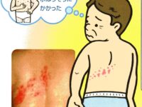 帯状疱疹の治療と予防
