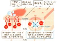 健康セミナー｜あせも(汗疹)