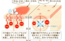健康セミナー「 あせも(汗疹)  」記事を掲出